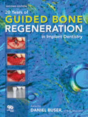 Image of 20 Years of Guided Bone Regenartion in Implant Dentistry