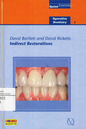 Image of Indirect Restorations