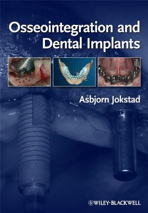 Image of Osseointegration and Dental Implants