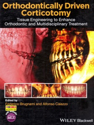Image of Orthontically DrivenCorticotomy:Tissue Engineering to Enhance Orthodontic and Multidisciplinary Treatment