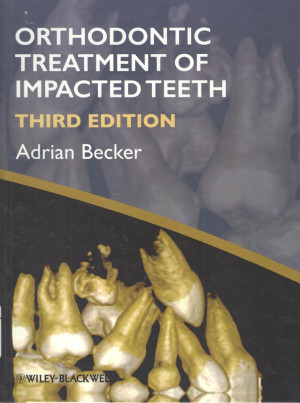 Image of Orthodontic Treatment of impacted Teeth